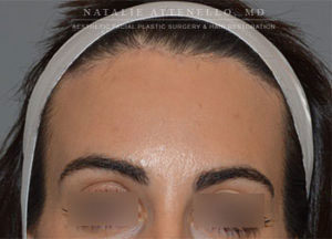 Close up view of forehead after hairline lowering procedure by Dr. Attenello in Beverly Hills, CA