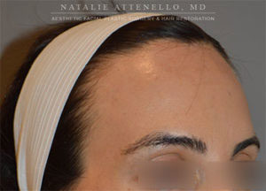 Patient before large forehead reduction/hairline lowering procedure by Dr. Natalie Attenello