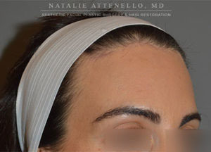 Final results of hairline lowering/forehead reduction surgery at Dr. Attenello's office in Beverly Hills