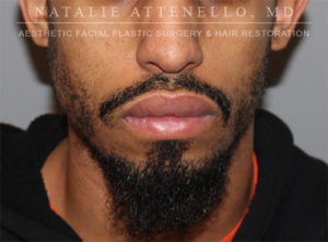 Hair Restoration Case 3909 Before Photo Hair Restoration