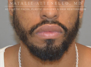 Hair Restoration Case 3909 After Photo Hair Restoration
