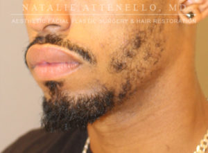Hair Restoration Case 3909 Before Photo Hair Restoration