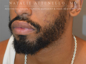 Hair Restoration Case 3909 After Photo Hair Restoration