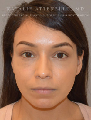 Nose Case 3958 After Photo Nose