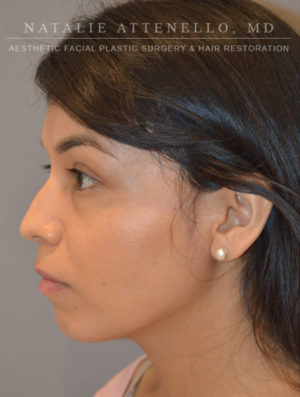 Nose Case 3958 Before Photo Nose
