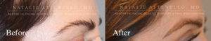 Eyebrow Transplantation Result Beverly Hills