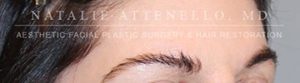 Hair Restoration Case 3999 Before Photo Hair Restoration