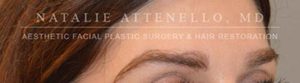 Hair Restoration Case 3999 After Photo Hair Restoration