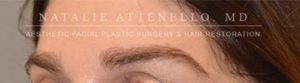 Hair Restoration Case 3999 After Photo Hair Restoration