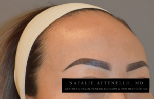 Close up view of a big forehead before patient undergoes a hairline lowering procedure by Dr. Natalie Attenello