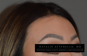 Results of forehead reduction surgery by aesthetic facial plastic surgeon Dr. Attenello