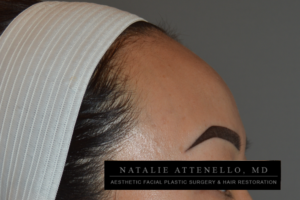 Close up view of patient's forehead before hairline lowering procedure by Dr. Attenello in Beverly Hills