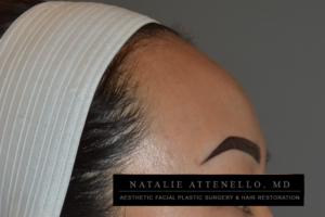 Hairline Lowering/Forehead Reduction