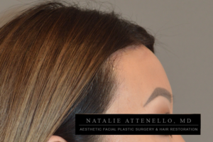 Final results of hairline lowering/forehead reduction facial plastic surgery procedure