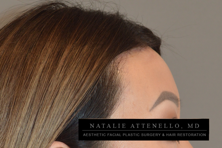 Hairline Lowering/Forehead Reduction