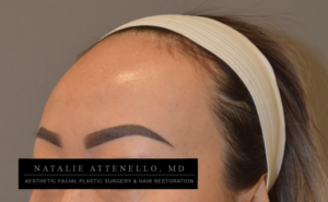Before photo of a hairline lowering/big forehead reduction facial plastic surgery procedure