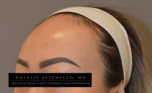 Hairline Lowering/Forehead Reduction