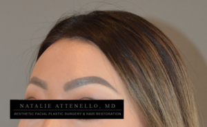 Close up view of forehead showing results of hairline lowering surgery by Dr. Natalie Attenello