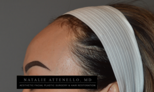 Patient before a forehead reduction procedure performed by Dr. Attenello in Beverly Hills, CA