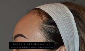 Hairline Lowering/Forehead Reduction