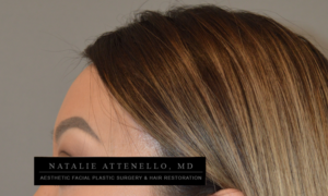 Hairline Lowering/Forehead Reduction