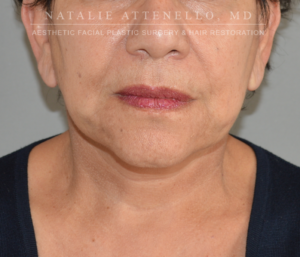 Facelift Case 4044 After Photo Facelift