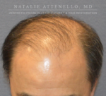 Hair Restoration