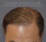 Hair Restoration