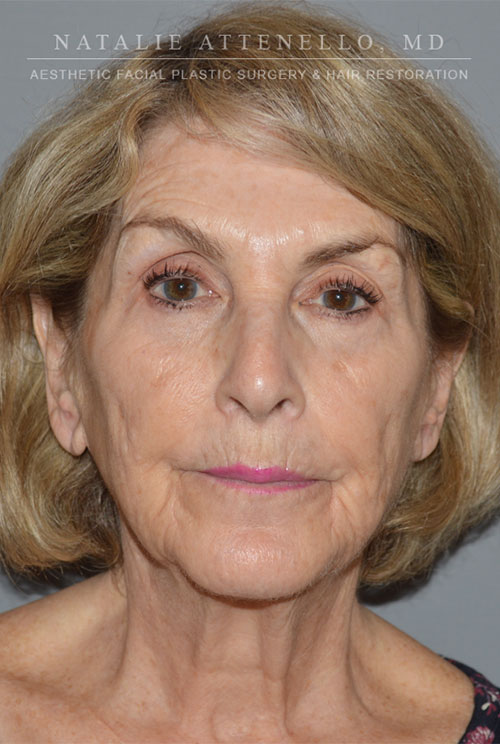 Facelift