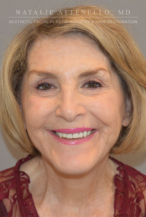 Facelift