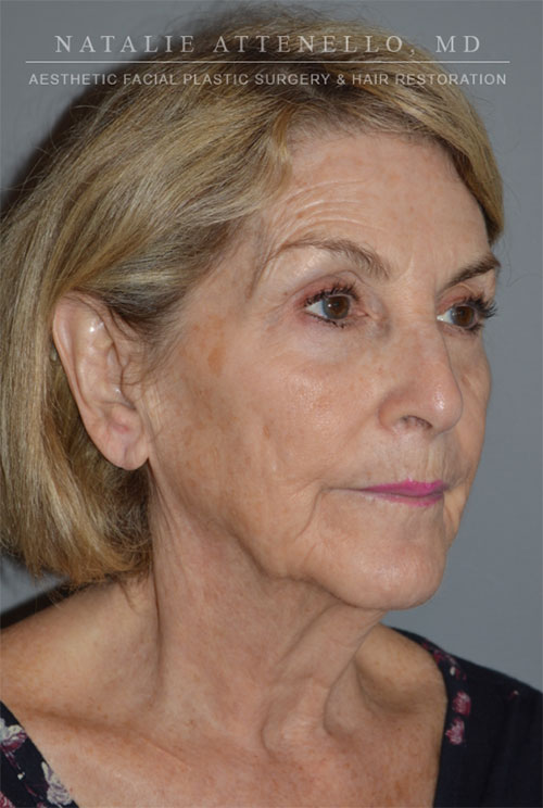 Facelift