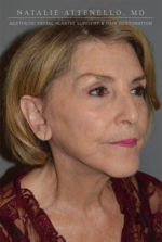 Facelift
