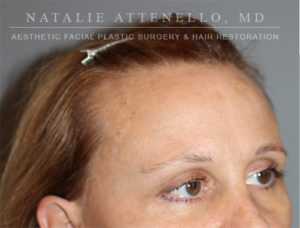 Hair Restoration Case 4122 Before Photo Hair Restoration
