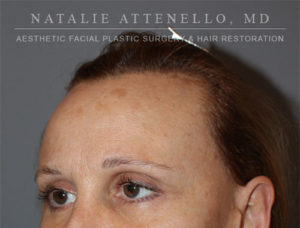 Hair Restoration Case 4122 Before Photo Hair Restoration