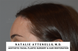 Close up side view of patient's forehead after hairline lowering procedure by Dr. Natalie Attenello