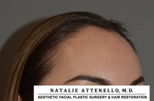 Close up view of patient's forehead before hairline lowering by Dr. Natalie Attenello in Beverly Hills