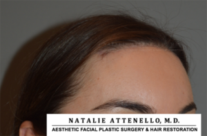 Close up view of patient's forehead after hairline lowering procedure by Dr. Natalie Attenello