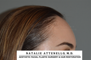 Close up side view of patient's forehead before hairline lowering procedure by Dr. Natalie Attenello