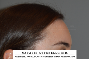 Close up side view of patient's forehead after hairline lowering procedure by Dr. Natalie Attenello