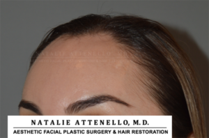 Before photo showing patient who will undergoe forehead reduction surgery by Dr. Attenello in Beverly Hills