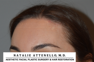 Final results of patient who underwent hairline lowering surgery performed by Dr. Natalie Attenello