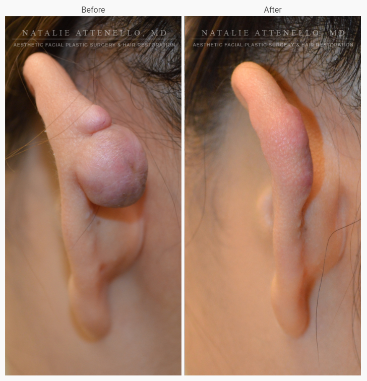 A closeup of a patient’s ear before surgery next to a closeup of the same ear after a successful otoplasty surgery.