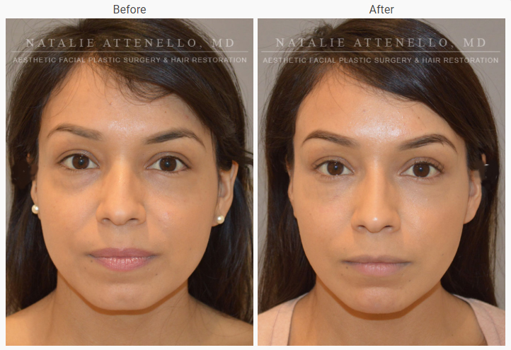 A female patient staring at the camera before surgery and the same patient staring at the camera after a rhinoplasty.