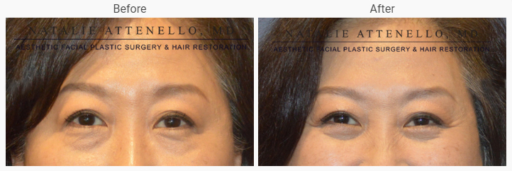 Blepharoplasty Eyelift Results Beverly Hills