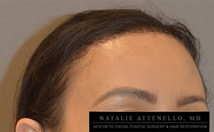 Hairline Lowering/Forehead Reduction