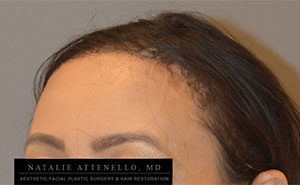 Hairline Lowering/Forehead Reduction