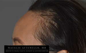 Hairline Lowering/Forehead Reduction