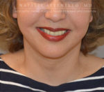 Facelift