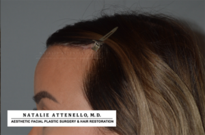 Side view of patient after undergoing hairline lowering/forehead reduction surgery by Dr. Natalie Attenello
