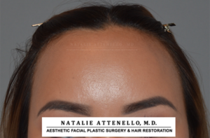 Close up view of patient's forehead before hairline lowering by Dr. Natalie Attenello in Beverly Hills